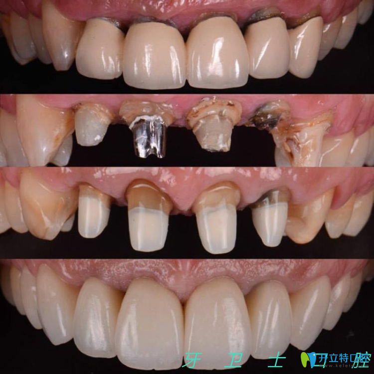 種植牙前后對比案例