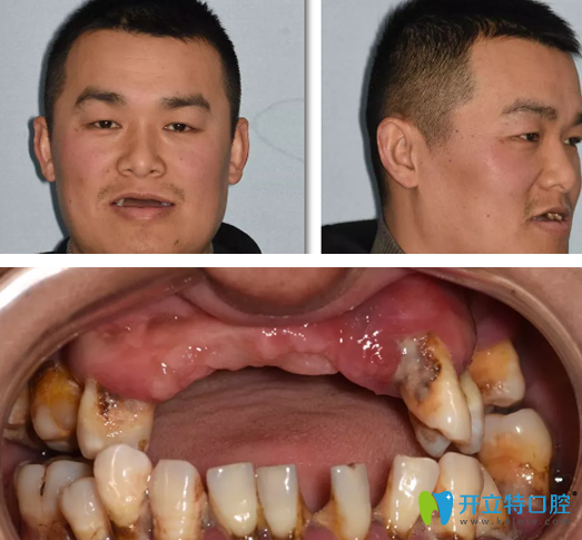 男子在重慶牙博士做即刻種植牙案例：術(shù)后即刻當(dāng)眾吃蘋果