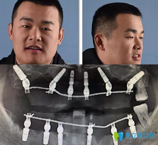 重慶牙博士徐孟輝種植牙術后即刻照片及修復后CBCT影像