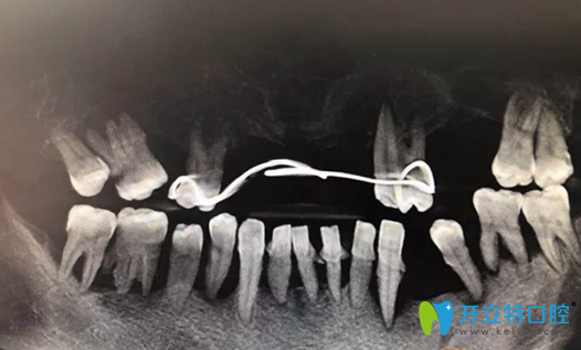 重慶牙博士種植修復前CBCT影像