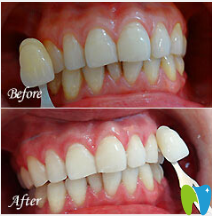 廣州暨博口腔黃曉雁牙齒美容案例對比圖