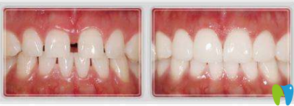 口腔牙齒磨損修復(fù) 口腔牙齒磨損修復(fù)