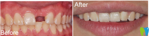 洛陽澗西維樂口腔案例