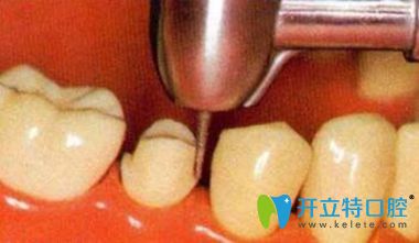 全瓷牙優(yōu)點(diǎn) 全瓷牙優(yōu)點(diǎn)