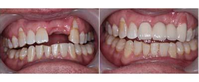 牙齒缺失不再怕 東營(yíng)同泰李文濤助你種植一口漂亮牙