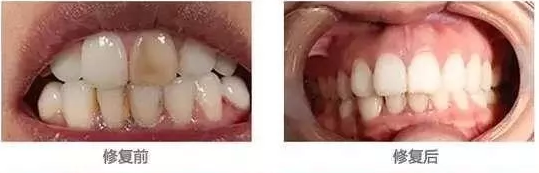 我們的牙齒為什么這么黃？新鄉(xiāng)貝特口腔教你來變白