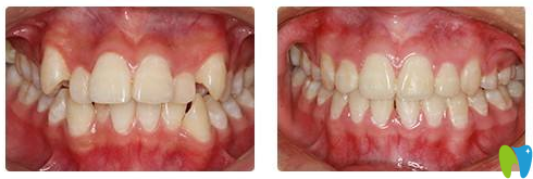 廣州拜博口腔牙齒矯正案例對比圖