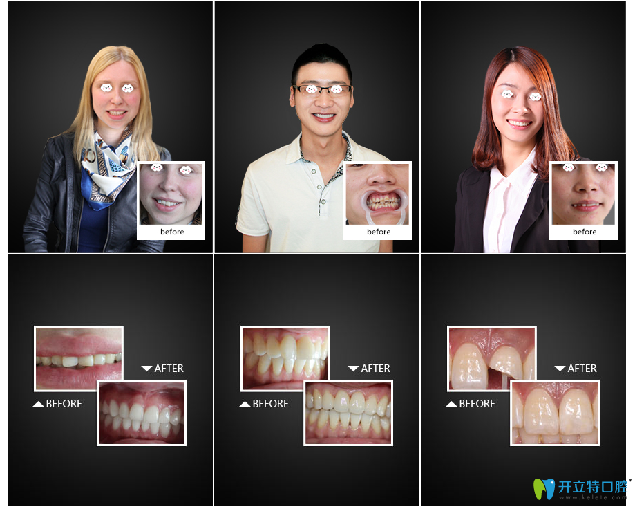 溫州牙博士口腔牙齒整形案例