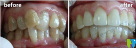 廈門登特口腔劉嚴(yán)主任牙齒畸形矯正效果圖