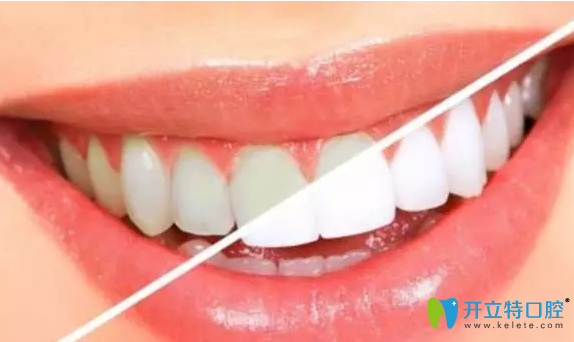 咸陽(yáng)三秦牙齒美白效果 咸陽(yáng)三秦牙齒美白效果