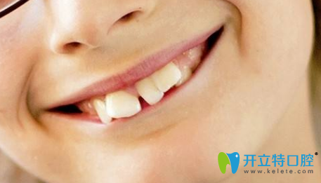 孩子牙齒不好哪個(gè)年齡段整牙好？3M隱形牙套還你整齊牙齒