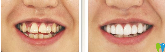 矯正前后 矯正前后