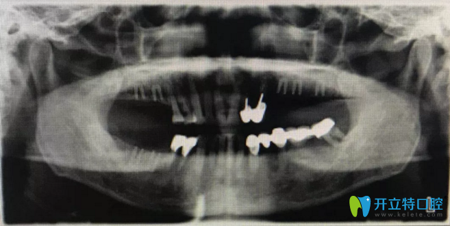 術前擬植入位點設計