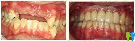 廈門登特口腔黃建生醫(yī)生種植牙效果圖