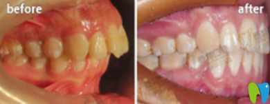 廈門登特口腔南祥明口腔正畸案例效果圖