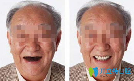 珠海拜博口腔賴春光全口種植牙效果 珠海拜博口腔賴春光全口種植牙效果