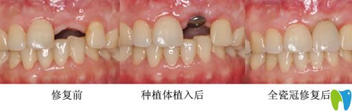 長春晟諾口腔唐永旺院長種植牙案例