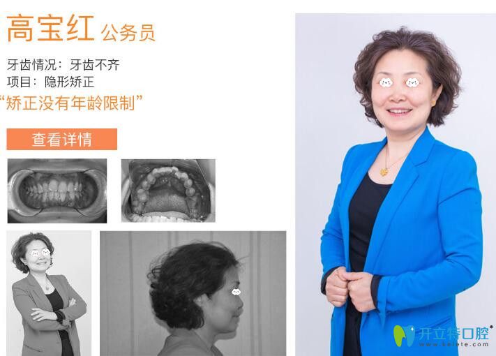 圣潔口腔牙齒不齊隱形矯正案例 圣潔口腔牙齒不齊隱形矯正案例