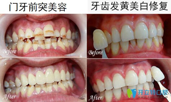 惠州致美口腔馬文智牙齒美學(xué)修復(fù)案例 惠州致美口腔馬文智牙齒美學(xué)修復(fù)案例