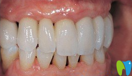 登特口腔種植牙后效果圖