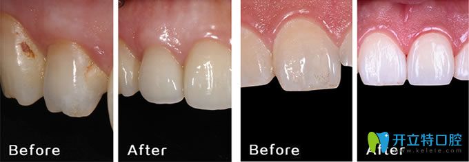 長(zhǎng)春晟諾口腔牙齒修復(fù)案例 長(zhǎng)春晟諾口腔牙齒修復(fù)案例