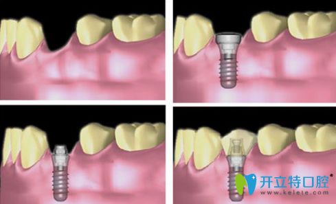 牙齒種植 牙齒種植
