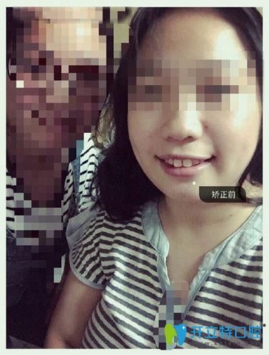 矯正之前牙齒不整齊