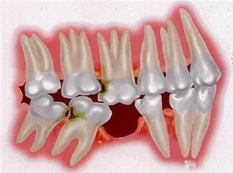 牙齒缺失了 這有三種修復(fù)手段哪種會(huì)比較好？