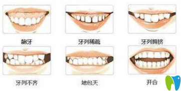 牙列不齊 牙列不齊