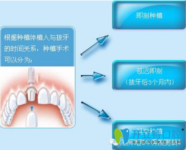 微創(chuàng)種植 微創(chuàng)種植