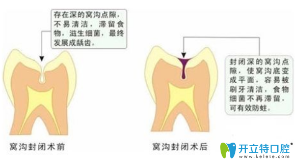 九江奇洋口腔醫(yī)生科普：兒童做窩溝封閉前不得不看的問(wèn)題