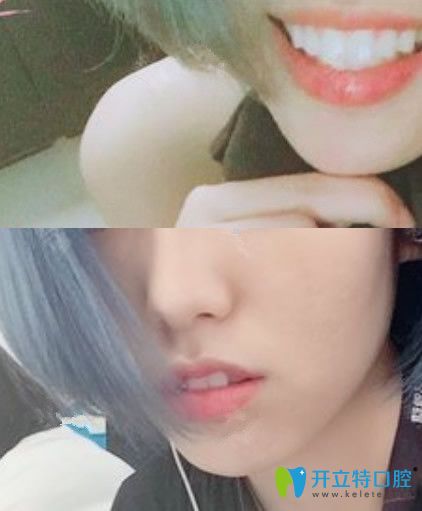 隱形托槽矯正401天效果圖