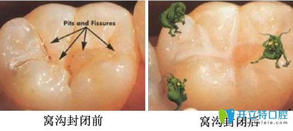 兒童做窩溝封閉前后對(duì)比圖
