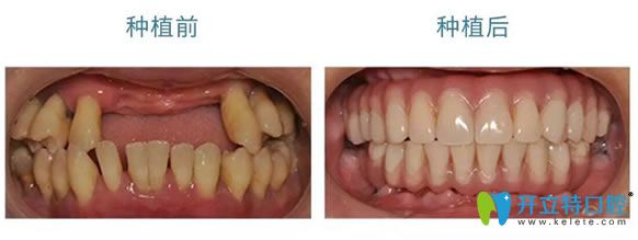 南京丹德齒科婁鐵贏種植牙案例