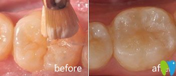 兒童齒科案例分享