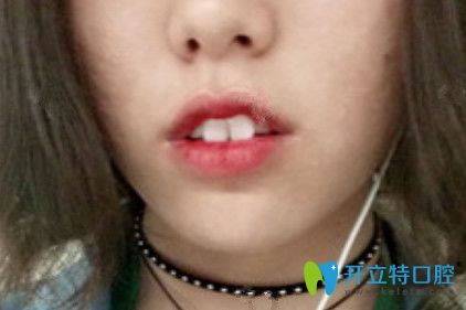在九江奇洋口腔做了牙齒矯正，我擺脫了“兔牙妹”稱號(hào)