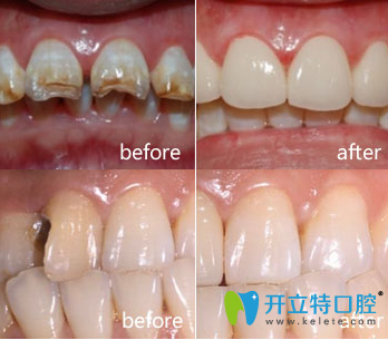 口腔修復(fù)案例分享
