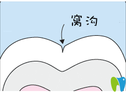 秦皇島口腔為6-9歲孩子免費(fèi)進(jìn)行窩溝封閉