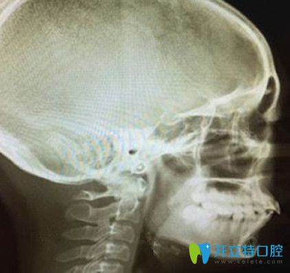 牙齒矯正術(shù)前拍片側(cè)面牙齒照片