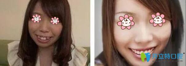 馬曉春院長牙齒矯正案例 馬曉春院長牙齒矯正案例