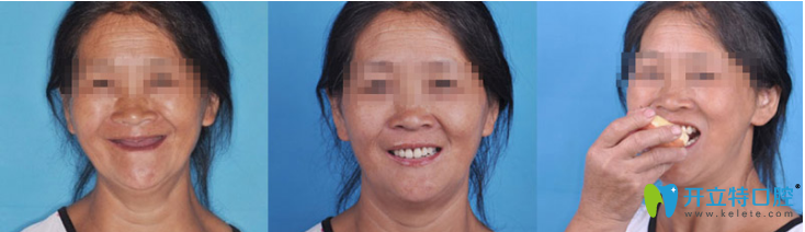 致美口腔種植案例--當日即食