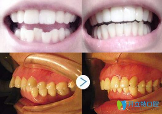 九江奇洋口腔馮蘭醫(yī)生牙齒矯正案例對(duì)比圖