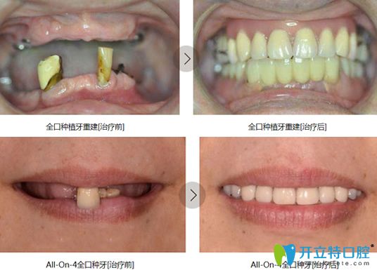 鎮(zhèn)江拜博口腔院長(zhǎng)萬(wàn)書(shū)健全口牙種植案例前后對(duì)比圖