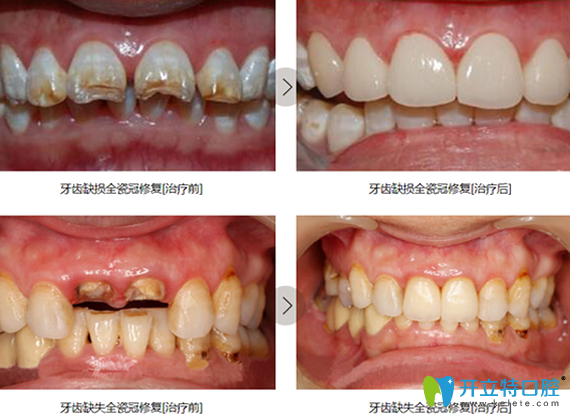 江蘇鎮(zhèn)江拜博口腔牙齒美學(xué)修復(fù)案例