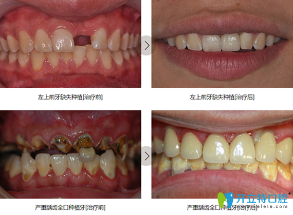 鎮(zhèn)江拜博口腔牙齒種植案例對(duì)比圖