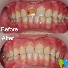 茂名致美牙齒修復案例