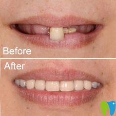 致美全口牙缺失案例