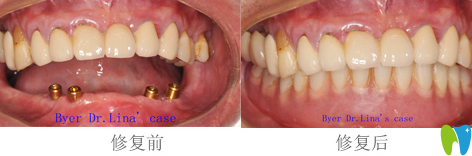 拜博拜爾口腔沙金賀醫(yī)生種植牙效果圖 拜博拜爾口腔沙金賀醫(yī)生種植牙效果圖