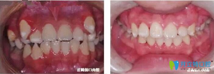 張學(xué)鵬主任牙齒正畸案例 張學(xué)鵬主任牙齒正畸案例