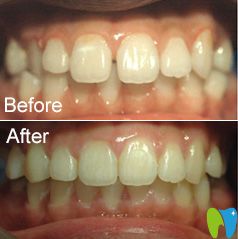 茂名致美牙齒稀疏真人案例